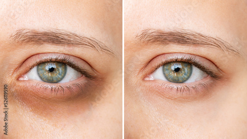 Cropped shot of young caucasian woman's face with dark circles under eyes before and after cosmetic treatment on a white bqckground. Bruises under eyes. Result of using concealer