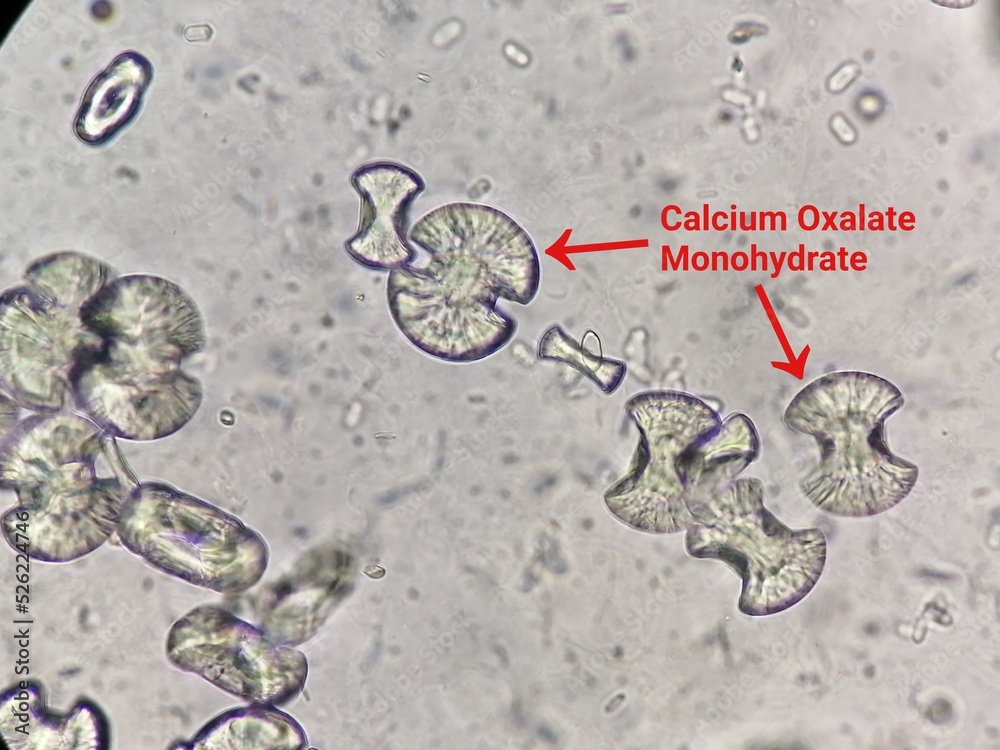 Plakát Microscopic image showing calcium oxalate monohydrate crystal ...