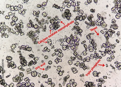 Murais de parede Microscopic image showing calcium oxalate monohydrate, uric acid crystals and triple phosphate crystals from urine sediment
