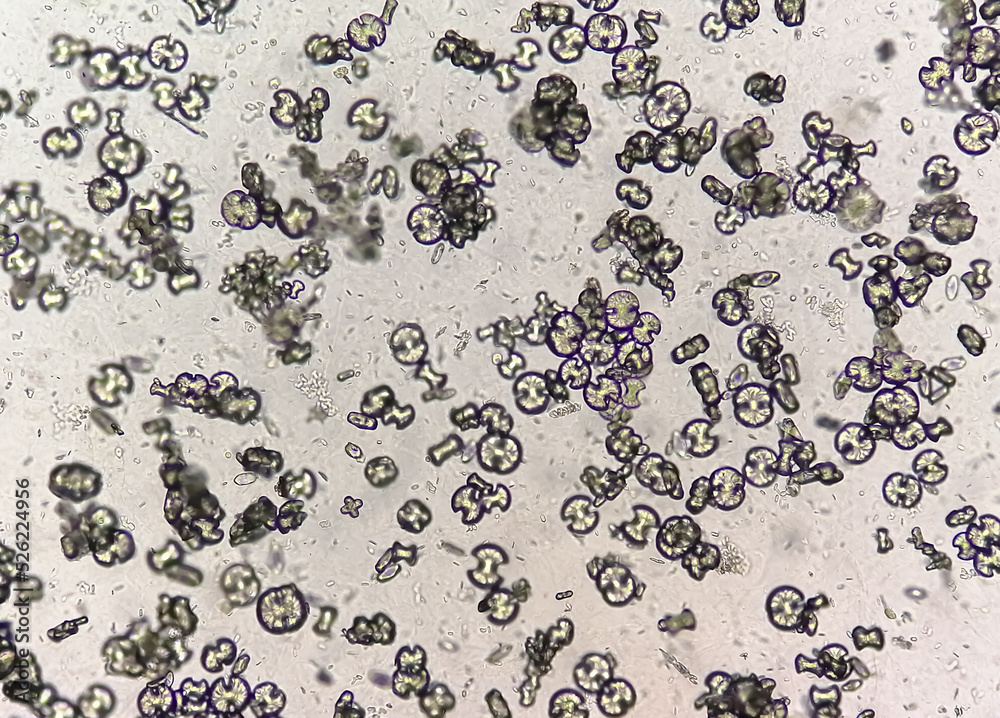 Microscopic Image Showing Calcium Oxalate Monohydrate Uric Acid 