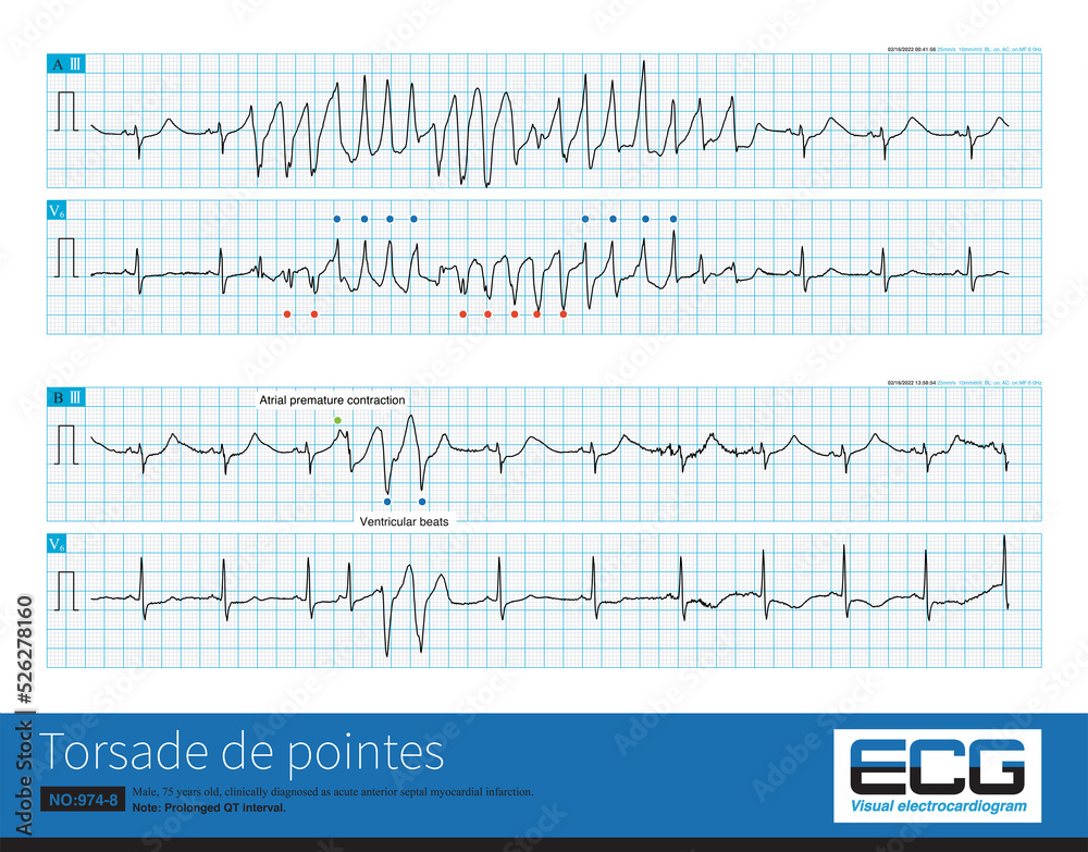 Acute myocardial ischemia can lead to secondary long QT syndrome, R on T ventricular premature contraction and torsade de pointes. Acute myocardial ischemia can lead to secondary long QT syndrome, R on T ventricular premature contraction and torsade de pointes.