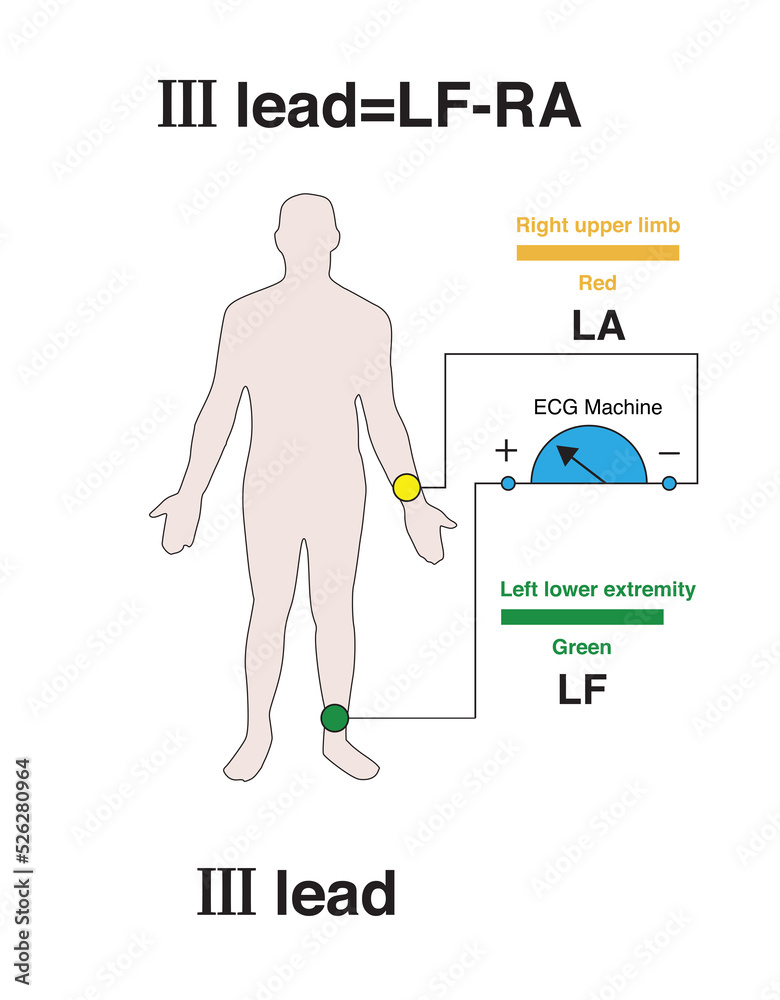 The positive electrode of lead Ⅲ of the ECG is placed on the left lower