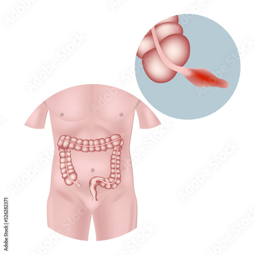 Inflammation of the appendix. Torso with intestines. Medical poster. Vector illustration
