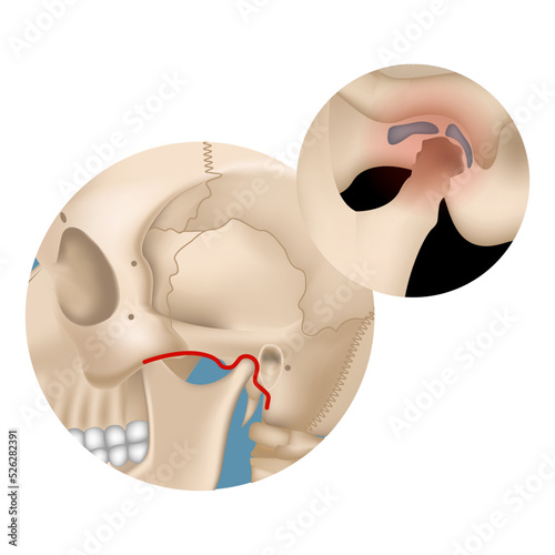 Arthritis of the jaw joint. Head bones inflammation infographic with designation. Medical poster. Vector illustration