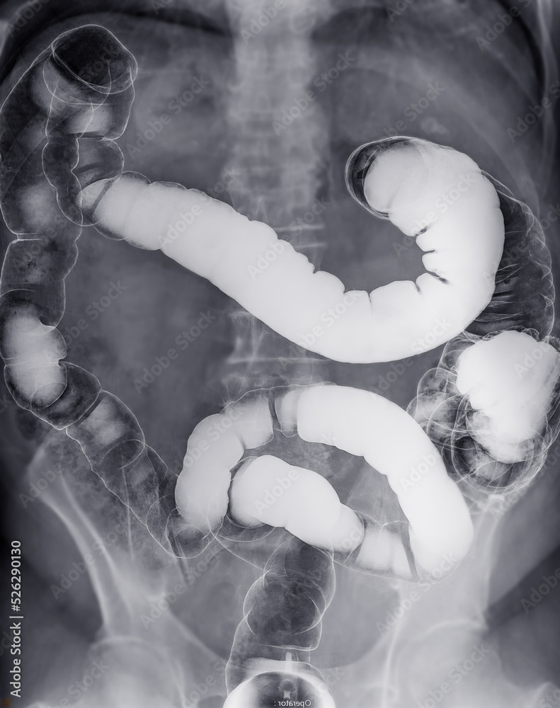 Bari Injection Barium enema or BE is image of large bowel after injection of barium ...