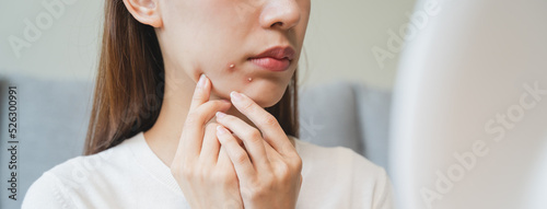 Obraz na plátně Asian young woman worry about acne on her face after wear face mask