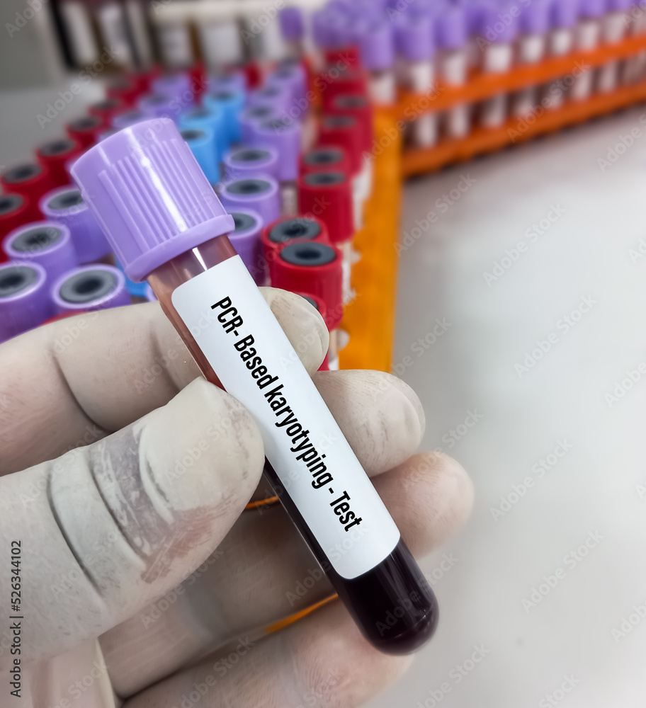 Blood sample for PCR based karyotyping testing. disorder