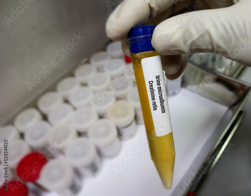 Urine Sample for Urine ACR or microalbumin creatinine Ratio test to diagnosis Chronic kidney disease (CKD). photo