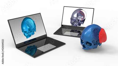 3D rendering - design a skull prothesis on a computer