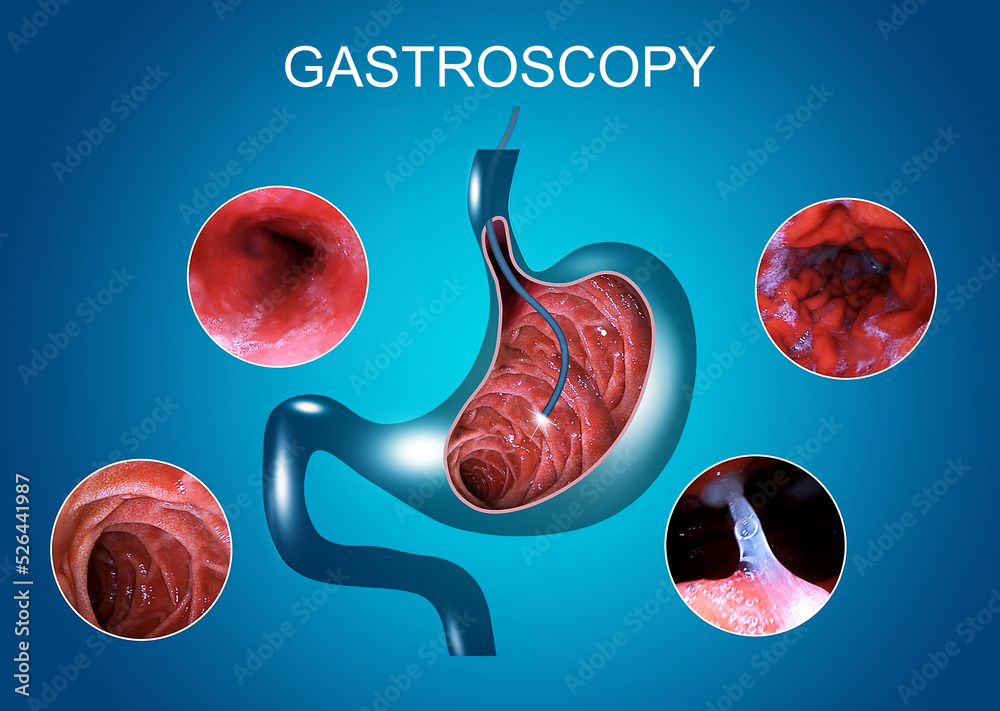 Digestive endoscopy or gastroscopy. Performing a gastroscopy procedure
