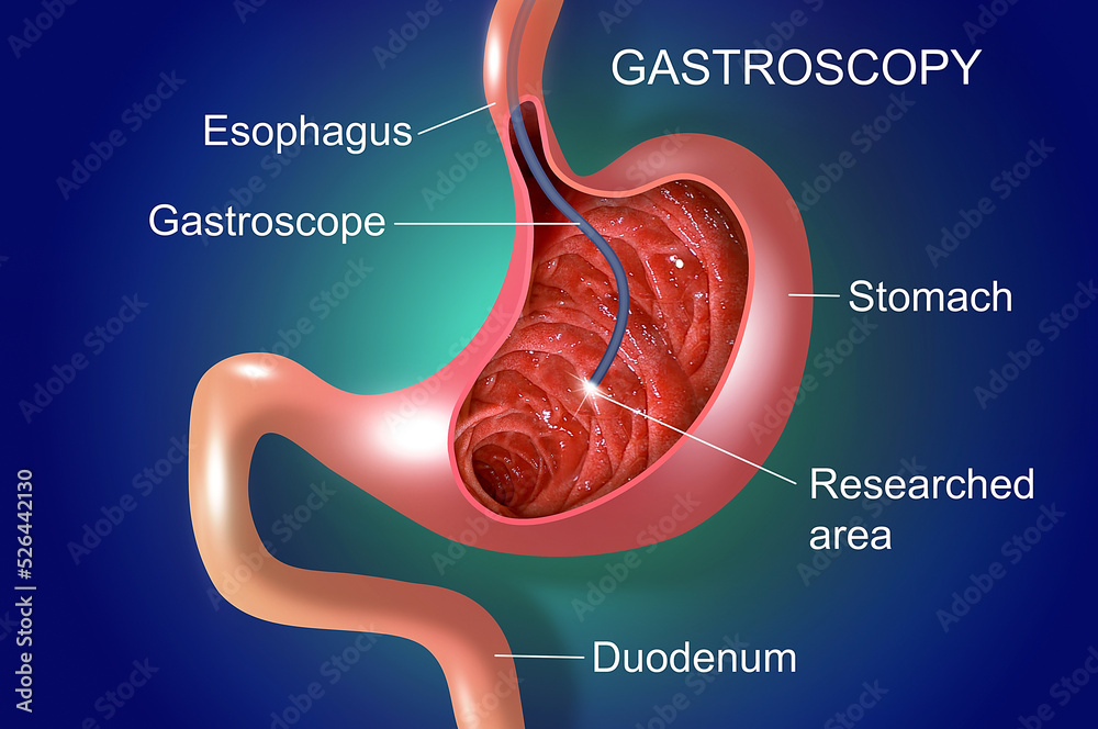 Digestive endoscopy or gastroscopy. Performing a gastroscopy procedure
