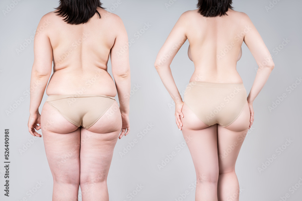 Young woman with excess fat on her back and arms and toned back before and  after losing weight isolated on a white background. Result of diet,  liposuction, training, healthy lifestyle Stock Photo