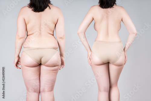 Woman's body before and after weight loss or liposuction on gray background, fat and thin female back and buttocks