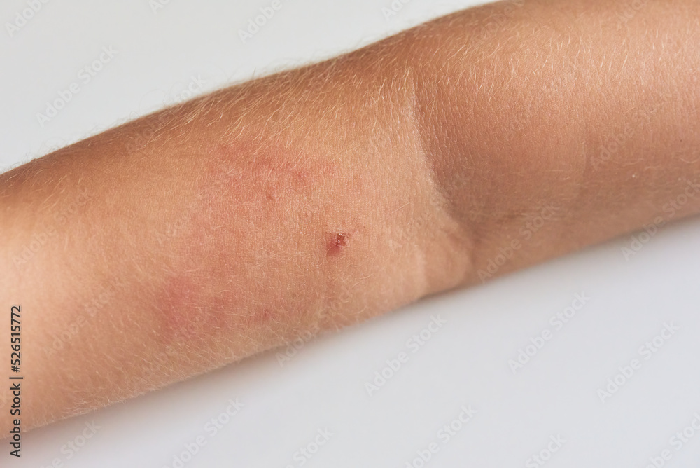 Fototapeta premium Insect bite on arm of child with allergic reaction