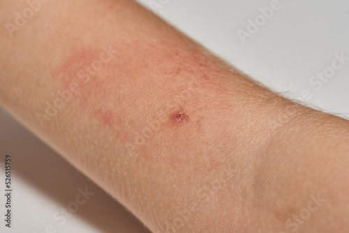Insect bite on arm of child with allergic reaction