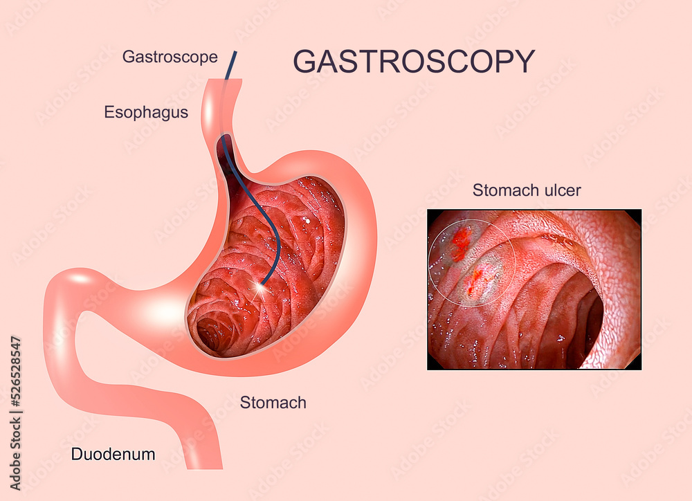 Digestive endoscopy or gastroscopy. Performing a gastroscopy procedure. Diagnostics of gastric diseases. Stomach health. Medical concept
