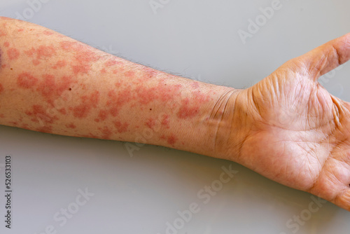 man's arm with herpes virus skin patches