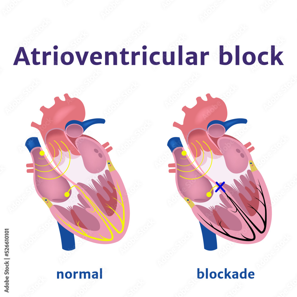 Atrioventricular block. Violation of the electrical signal in the heart