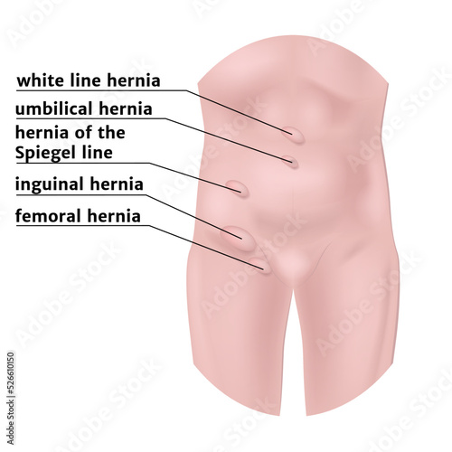 types of hernias in the abdominal cavity with a description. Medical infographic with human torso. Medical poster. Vector illustration