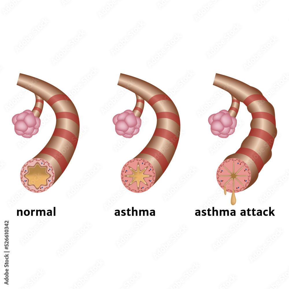 Bronchial asthma. Chronic inflammation of the lower respiratory tract