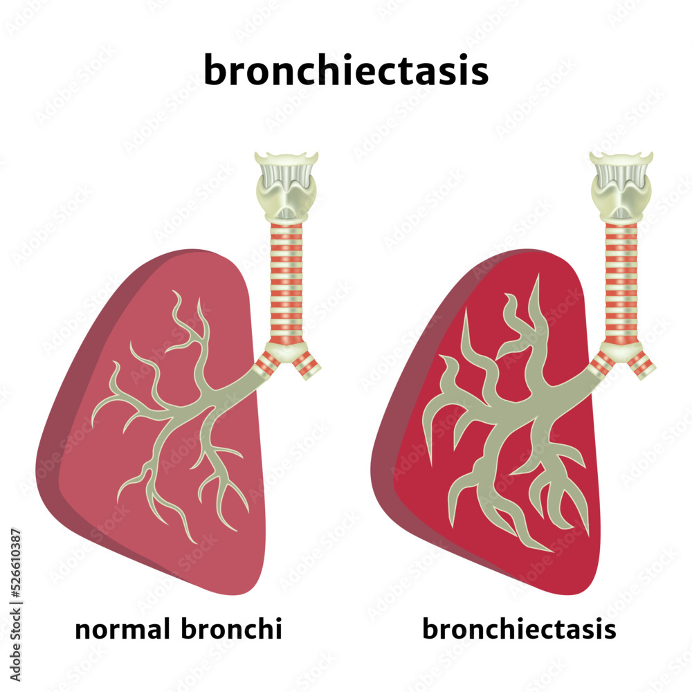Bronchiectasis. Enlargement of the airway lumen. Inflammation of the