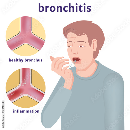Bronchitis. Illustration of a coughing man. Medical vector illustration