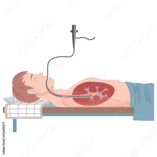Bronchoscopy. The patient is in the supine position. Medical examination. Vector flat illustration photo
