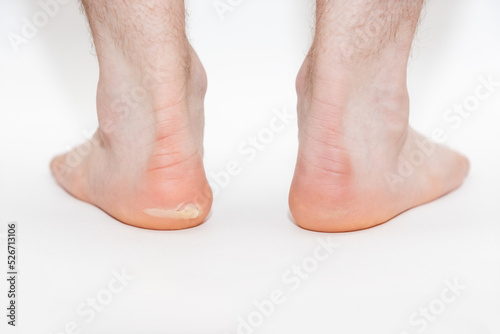 Two male feet with a burst callus. Close-up. White background. The concept of foot care and podology © _KUBE_