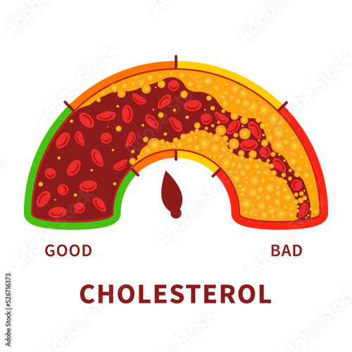 Cholesterol level on blocked blood vessel medical diagram. Meter gauge of bad hdl lipoprotein. High and low fat test indicator. Atherosclerosis risk. Healthcare concept. Vector illustration.