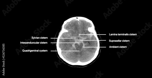 An axial CT scan of a patient who had lost consciousness revealed blood in the archnoid space. 