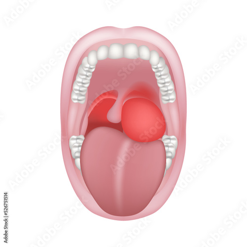 Peripharyngeal abscess. Purulent inflammation of the tissue of the peripharyngeal space. Wide open mouth with teeth. Vector illustration photo