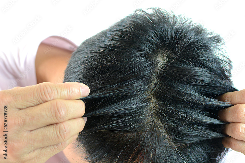 White hair problems in men, asian man with white hair, white hair or hair loss problem. White hair problems in men, asian man with white hair, white hair or hair loss problem.