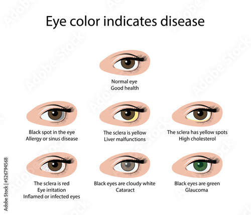 illustration of biology and medical, Eye color indicates disease, Signs of unhealthy eyes, Abnormal eye color indicates health or disease, eye infection, signs of health