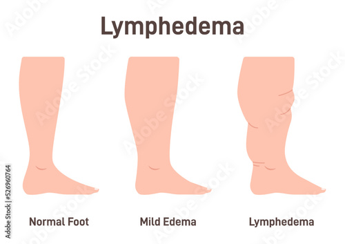 Lymphedema stages. Lymphatic system dysfunction disease. Swollen legs,