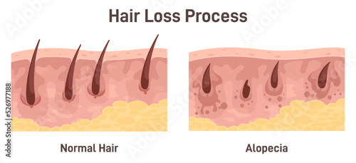Alopecia. Hair loss, balding process. Cross-section anatomical structure