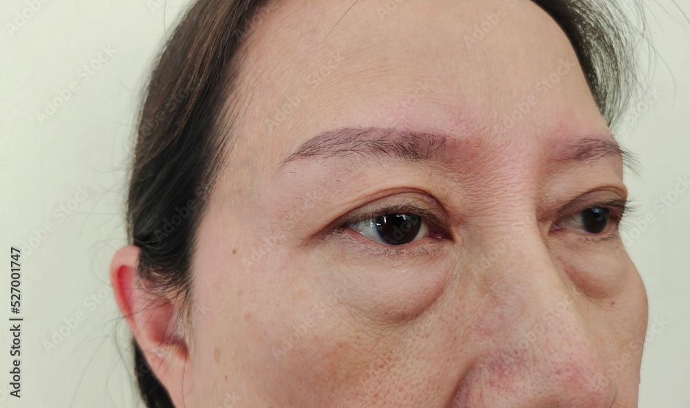 portrait showing the flabbiness adipose sagging skin under the eyes, freckles and blemish, problem wrinkles and dark spots on the face of the woman, concept health care. portrait showing the flabbiness adipose sagging skin under the eyes, freckles and blemish, problem wrinkles and dark spots on the face of the woman, concept health care.