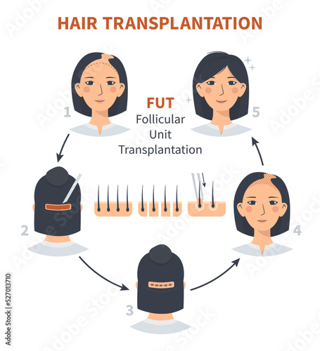 Stages of woman hair transplantation FUT Follicular Unit. Treatment surgery of baldness, alopecia, hair loss. Vector medical infographics, a female head scalp. Strip, graft machine.