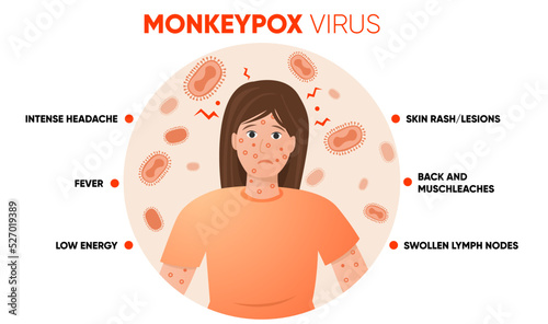 Monkeypox virus symptoms simple infographic. Poster for social media, articles and flyers. Vector illustration.