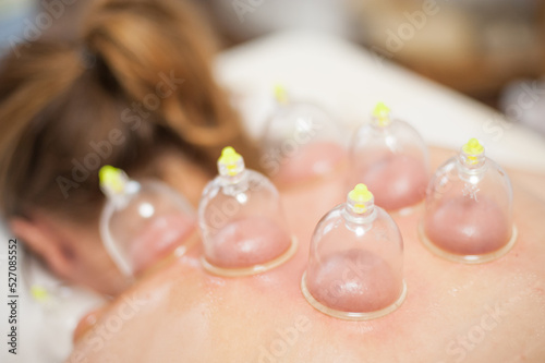 Glass vacuum cupping therapy on a woman's back, acupuncture treatment. Ventosa traditional massage. Alternative Medicine. Medical health care