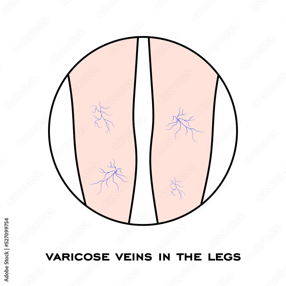 Varicose veins in the legs. Varicose spider veins anatomy. Swelling and