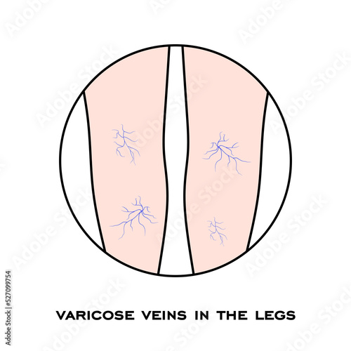 Varicose veins in the legs. Varicose spider veins anatomy. Swelling and pain in human legs. Vascular disease diagnostic and treatment. Abnormal blood pressure, weak vein and valves. vector