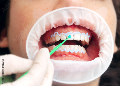 Close up of a tooth whitening procedure. Hygienist applying hydrogen peroxide on a patient