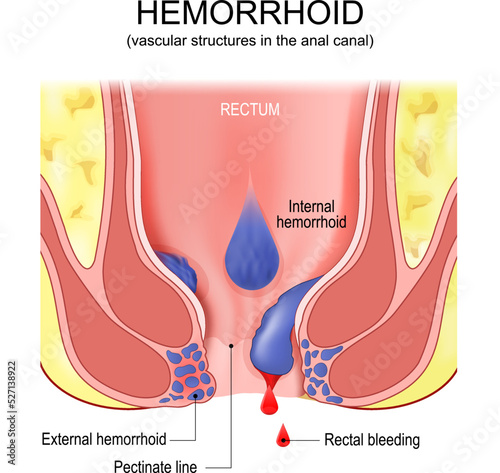 piles. hemorrhoids. Cross section of the rectum and anal canal photo