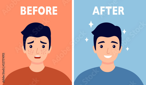 Man face acne before and after skin care treatment in flat design.