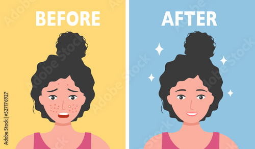 Woman face acne before and after skin care treatment in flat design.