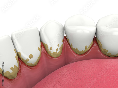 Bild auf Leinwand 3d render of lower jaw with calculus buildup on teeth line and making inflammati