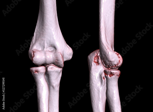 CT scan of elbow joint 3d rendering illustration of a painful elbow joint