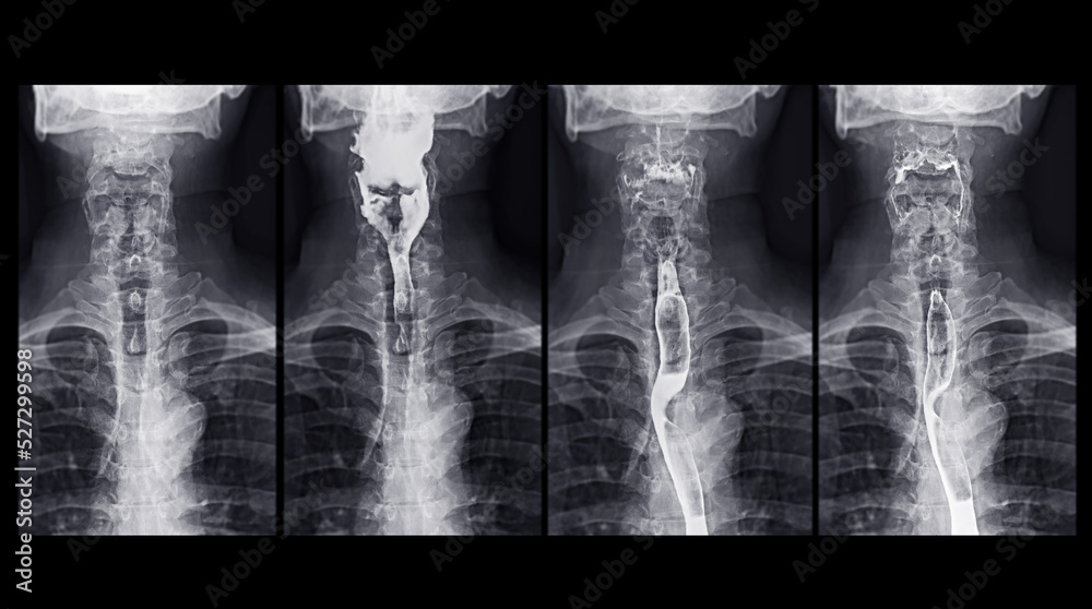 Fotka „Barium Swallow study test diagnose Barrett's GI tract exam GERD