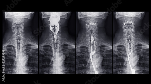 Barium Swallow study test diagnose Barrett's GI tract exam GERD ulcers series difficulty pharynx procedure UGI throat bowel therapy by fluoroscopy devices. photo