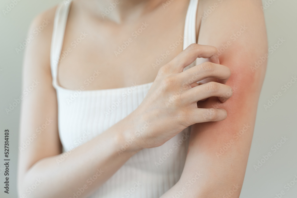 Sensitive skin allergic concept, Woman itching on her arm have a red rash from allergy symptom and from scratching. Sensitive skin allergic concept, Woman itching on her arm have a red rash from allergy symptom and from scratching.